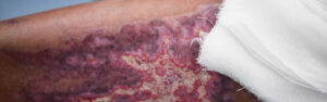 Burn Injury FAQs